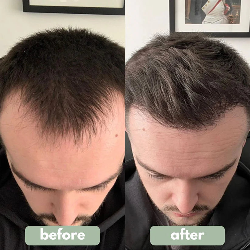 Fironya - Hair Growth Serum