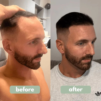 Fironya - Hair Growth Serum